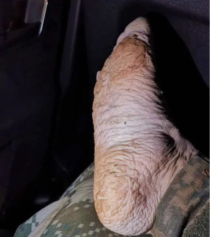 抗洪战士受伤的腿图片